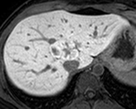 Liver Atlas Case 196 Focal Nodular Hyperplasia Fnh Typical Fnh
