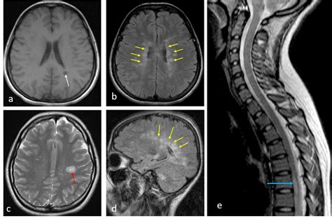 Multiple Sclerosis Radiology Cases