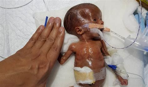Baby Born 14 Weeks Prematurely Becomes One Of The Smallest To Survive