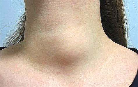 Thyroid Cancer Symptoms Diagnosis Surgery Treatment And Prognosis