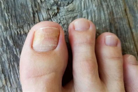 Common Nail Conditions Diagnosis And Treatment Options