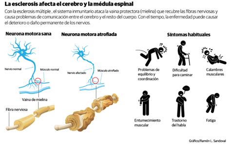 Segunda forma más común, que afecta a más o menos a 10 a 20 % de las personas con esclerosis múltiple. Esclerosis múltiple, la enfermedad de las "mil caras ...