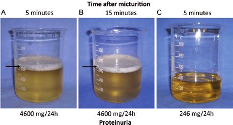 Prolonged foamy urine 5 minutes ( A ) and 15 minutes ( B ) after ...