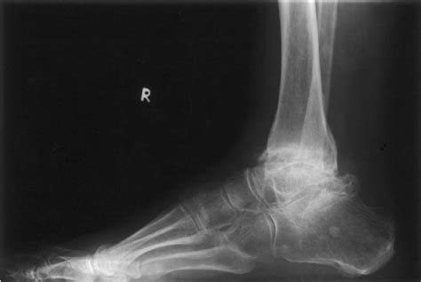 Lateral Radiograph Of Ankle Showing Degenerative Changes In Ankle And
