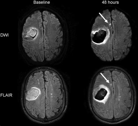 Neuroimaging Demonstration Of Evolving Small Vessel Ischemic Injury In