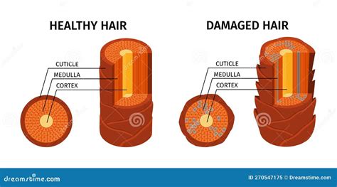 Damaged Cuticle Layer Cause Damaged Hair Cartoon Vector Cartoondealer