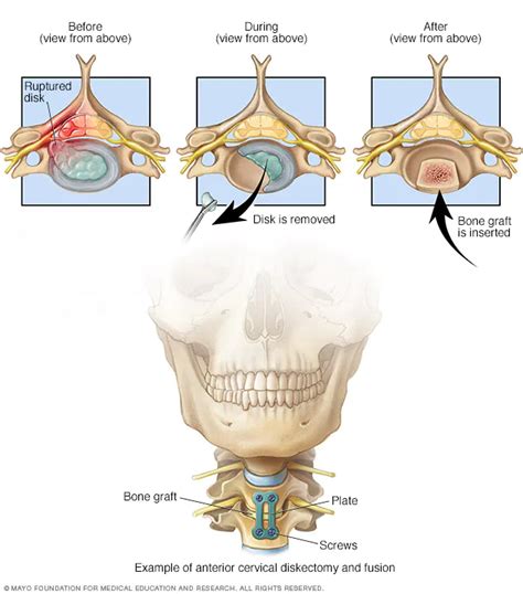 Spinal Fusion Oaklawn