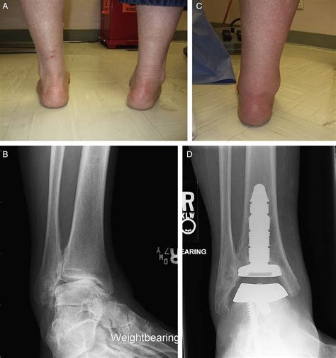 Total Ankle Replacement In The Varus Ankle The Journal Of Foot And