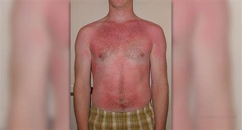 Sunburn Treatment Facts General Center SteadyHealth Com