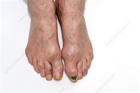 Gout In The Toes Stock Image C0142450 Science Photo Library