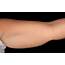 Upper Arm Fat  Humphrey Cosmetic Dermatology