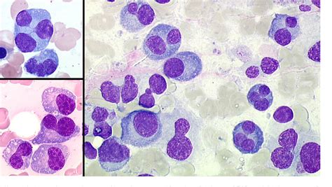 Figure 17 From Plasma Cell Morphology In Multiple Myeloma And Related