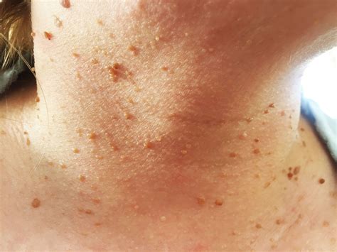 12 Bumps On Your Skin That Are Totally NormalAnd You Shouldn T Pop