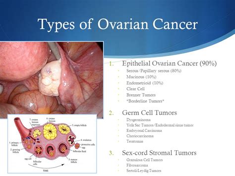 Ovarian cancer is when abnormal cells in the ovary begin to multiply out of control and form a tumor. How to Know Symptoms, Types and Causes Ovarian Cancer ...
