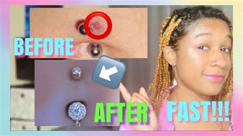 How To Get Rid Of A Bumpkeloid On Belly Piercing Real Divyne Youtube