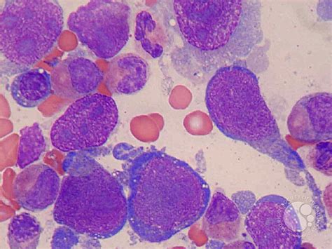 Intravascular Lymphoma Cells In The Bone Marrow Smears 1