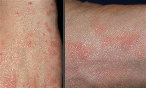 Pictures Of Skin Rashes Lovetoknow Health And Wellness
