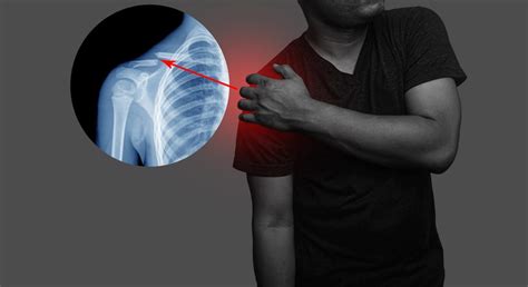 Collarbone Pain Causes And Best Treatment Options In 2023