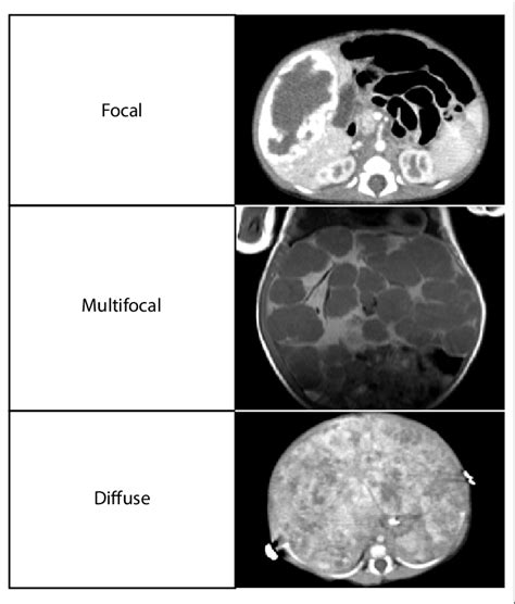 Clinical Classification Of Infantile Hepatic Haemangiomas Download