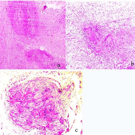 A Pathologic Findings Demonstrating Plexiform Schwannoma B Both