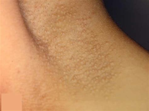Armpit Rash Itchy Candida Causes And Treatment