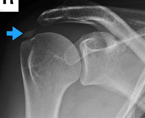 Shoulder Calcification