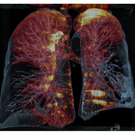 dual energy lung pbv pulmonary embolism bothside siemens
