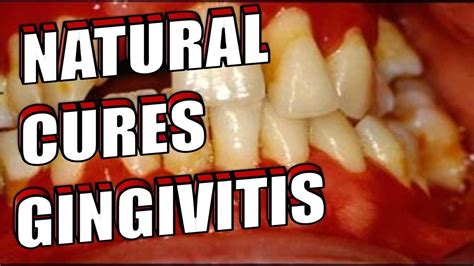 How To Get Rid Of Gingivitis At Home Naturally And Easily Gum Disease
