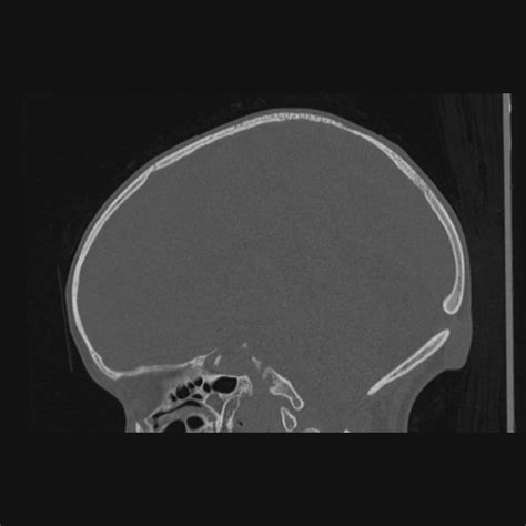 Atretic Occipital Cephalocele Image