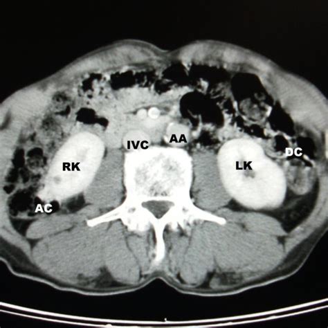 Abdominal Ct Scan At The Level Of Kidneys In A Patient In The Supine