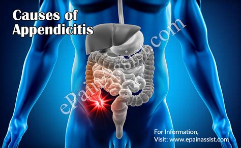 Appendicitis Treatment Causes Symptoms Signs Risk Factors