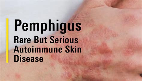 Understanding Pemphigus Types Causes And Symptoms