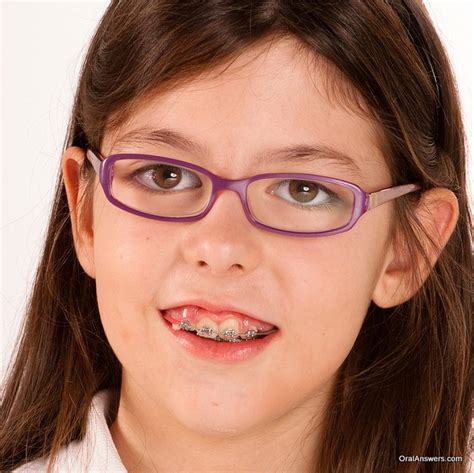 60 Photos Of Teenagers With Braces Robweigners Blog