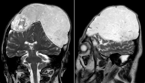 Giant Intradiploic Epidermoid Cyst With Large Osteolytic Lesions Of The