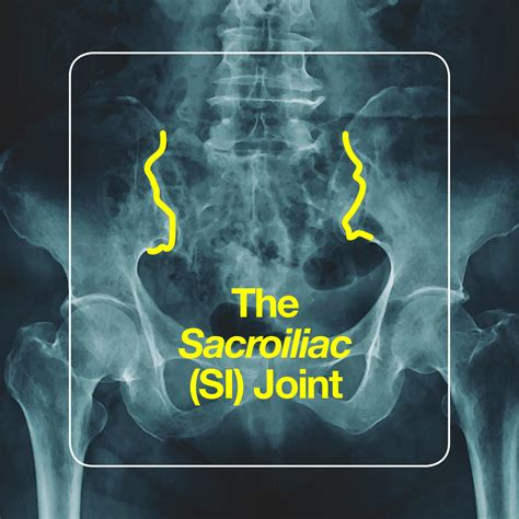 Si Joint Pain How To Identify Relieve Sacroiliac Joint Pain