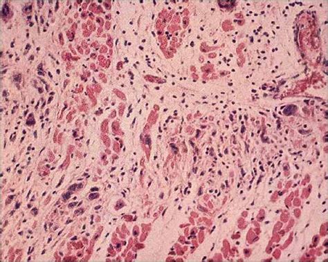 Myokarditis ist meist auf eine virusinfektion zurückzuführen. Rheumatische Myokarditis (Aschoff'sches Knötchen) _ bfdecont