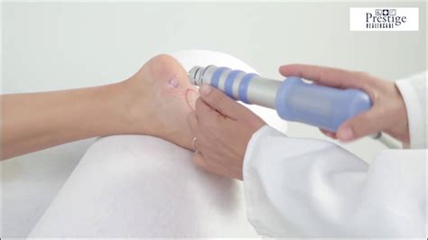 Shock Wave Therapy For Plantar Fasciitis Youtube