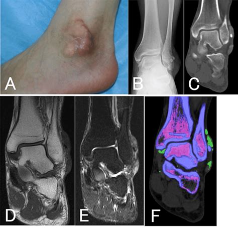 Cureus Three Cases Of Gouty Tophus In The Foot Treated By Resection