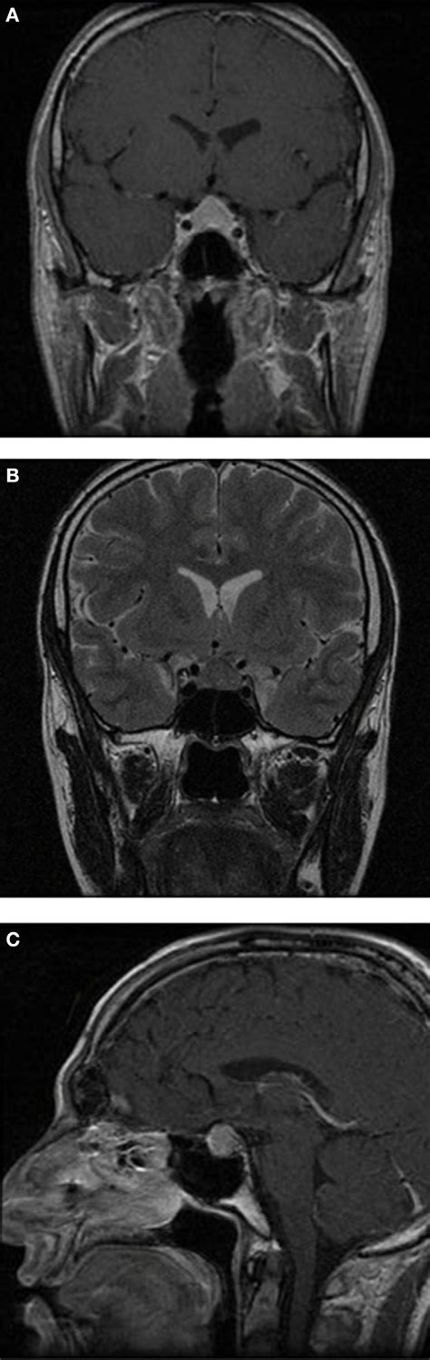 Brain Magnetic Resonance Imaging Mri Sections Brain Mri Showing A