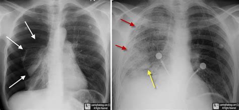 Learning Radiology Reexpansion Re Expansion Pulmonary Edema