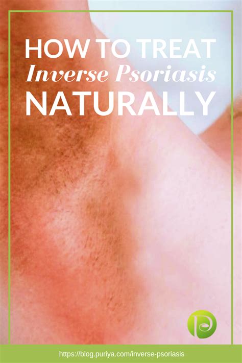 Inverse Psoriasis Uncovering This Less Common Type Of Psoriasis In
