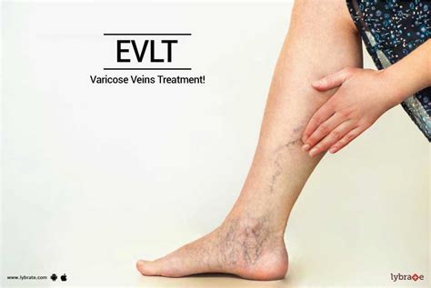 Evlt Varicose Veins Treatment By Dr Dilip S Rajpal Lybrate