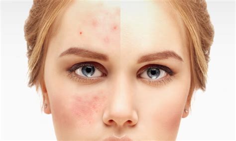 Ketogenic Diet Can Cure Acne