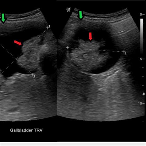 Transverse Ultrasound Of The Gallbladder Revealing Multiple