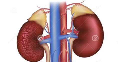 It is defined by the presence of reduced glomerular filtration rate (gfr). type2 diabetes and health related issues,food,recipes: how ...
