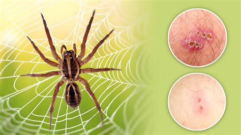 Spider Bite Identification Chart A Step By Step Guide