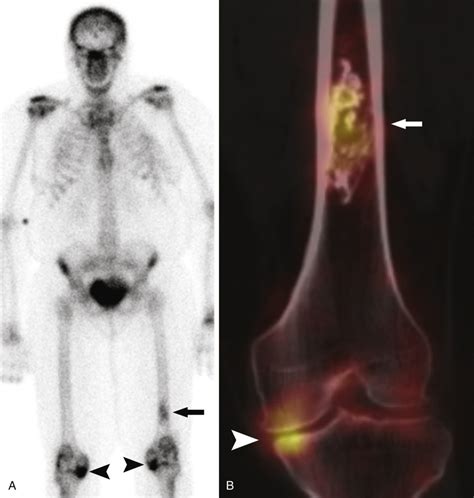 Clinical Considerations And Imaging Of Bone Tumors Basicmedical Key