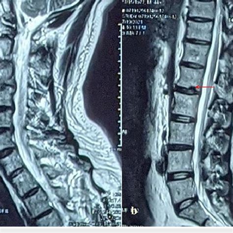 T2 Weighted Mri Sagittal View Of Whole Spine Showing Early