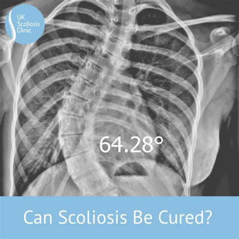 Can Scoliosis Be Cured Scoliosis Clinic Uk Treating Scoliosis Without Surgery