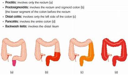 Ulcerative Colitis Classification Disease Proctitis Symptoms Crohns